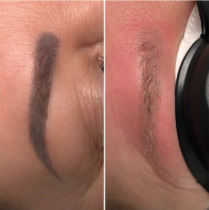 Brow Treatment